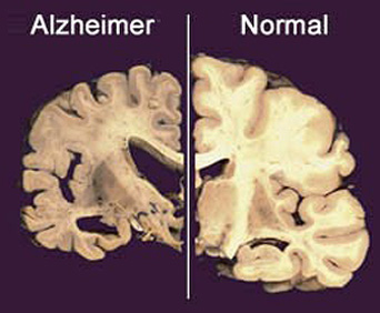 DOENÇA DE ALZHEIMER | Hospital Das Clínicas De Botucatu